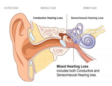 hearing loss types